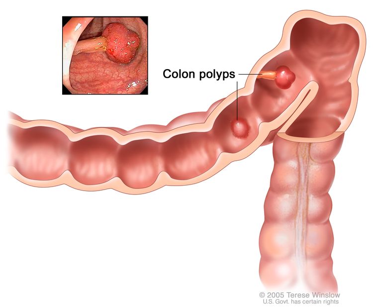 Colon polyps; shows two polyps (one flat and one pedunculated) inside the colon. Inset shows photo of a pedunculated polyp.