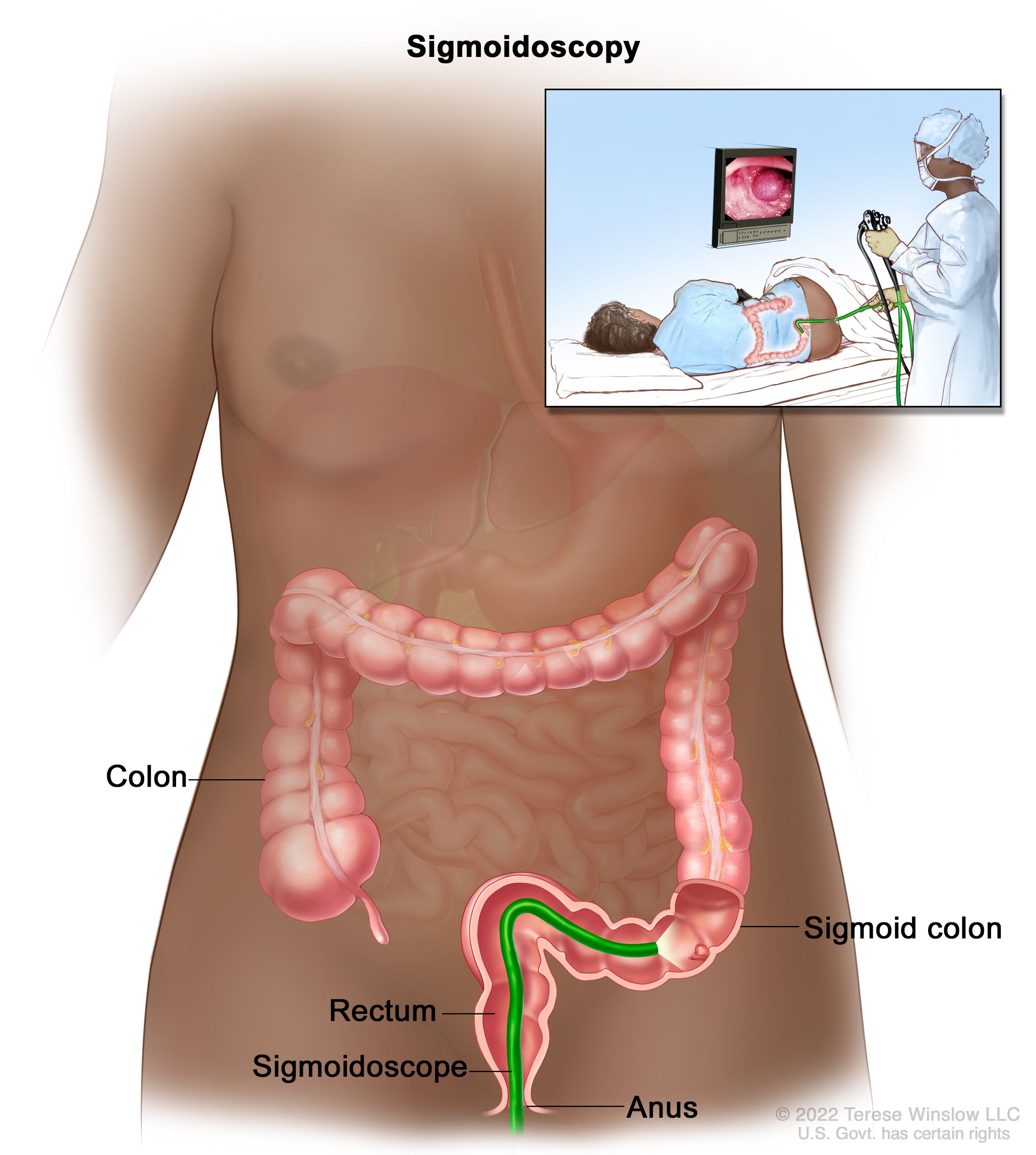 Colon Cancer Treatment Pdq Patient Version National Cancer Institute