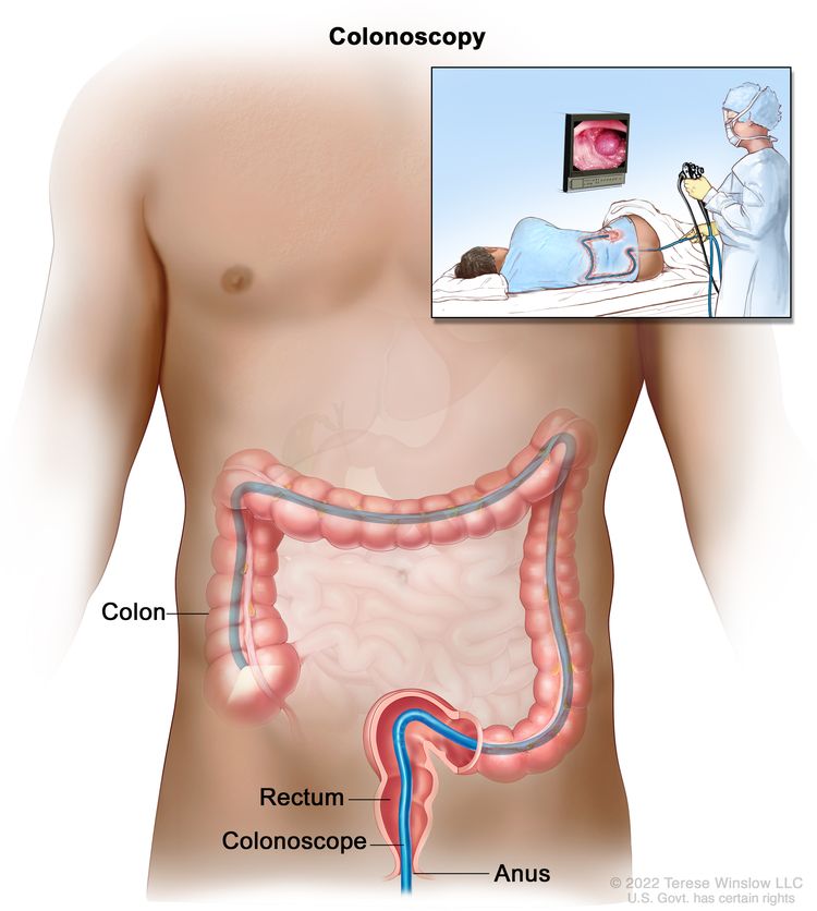 Colonoscopy; shows colonoscope inserted through the anus and rectum and into the colon. Inset shows patient on table having a colonoscopy.