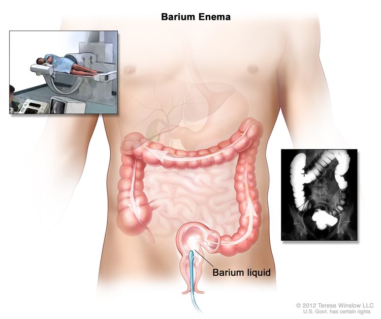 Barium enema procedure; shows barium liquid being put into the rectum and flowing through the colon. Inset shows person on table having a barium enema.