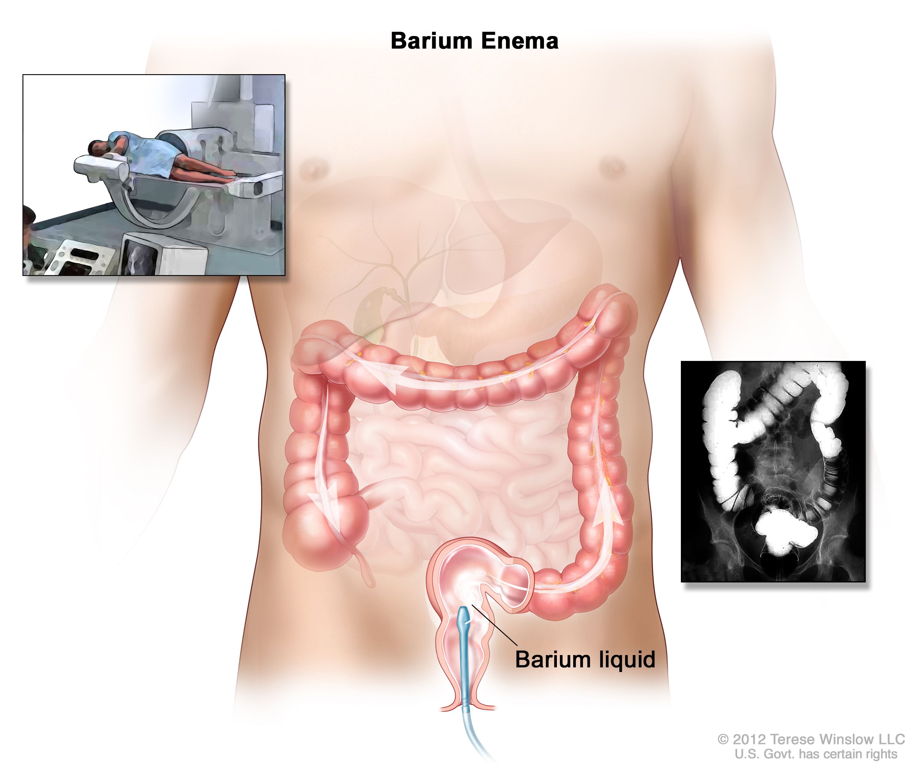 Sigmoid Colon Cancer X Ray Sigmoid Colon High Resolution Stock