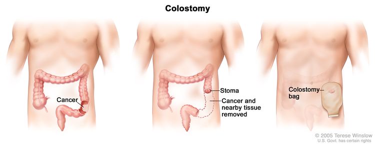 Three-panel drawing showing colon cancer surgery with colostomy; first panel shows the area of the colon with cancer, middle panel shows the cancer and nearby tissue removed and a stoma created, last panel shows a colostomy bag attached to the stoma.