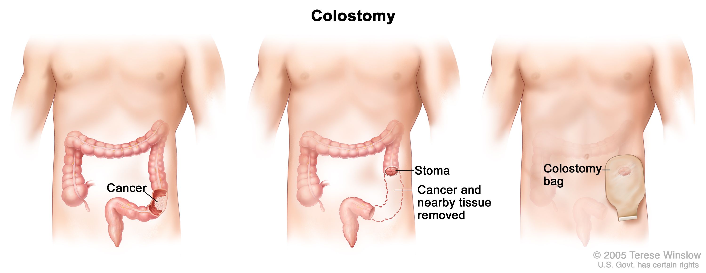 cancer colon resection