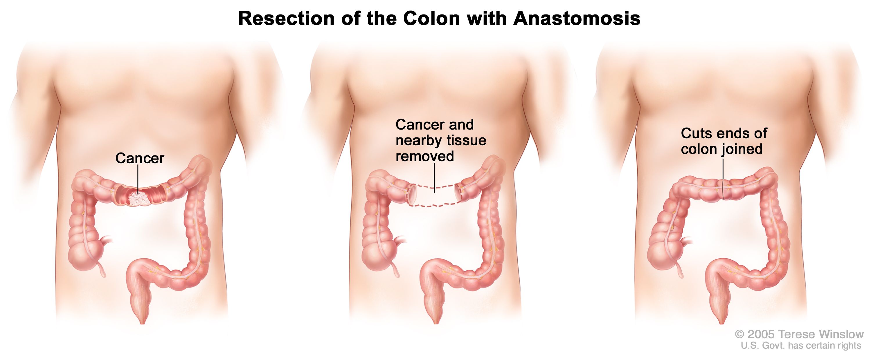 cancer colon operation)