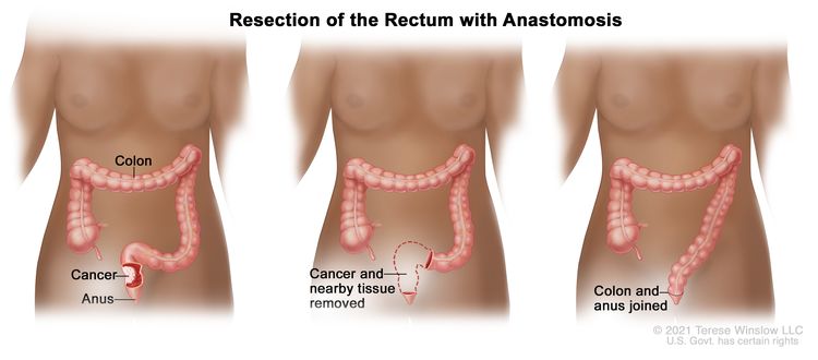 Three-panel drawing showing rectal cancer surgery with anastomosis; the first panel shows area of rectum with cancer, the middle panel shows cancer and nearby tissue removed, and the last panel shows the colon and anus joined.