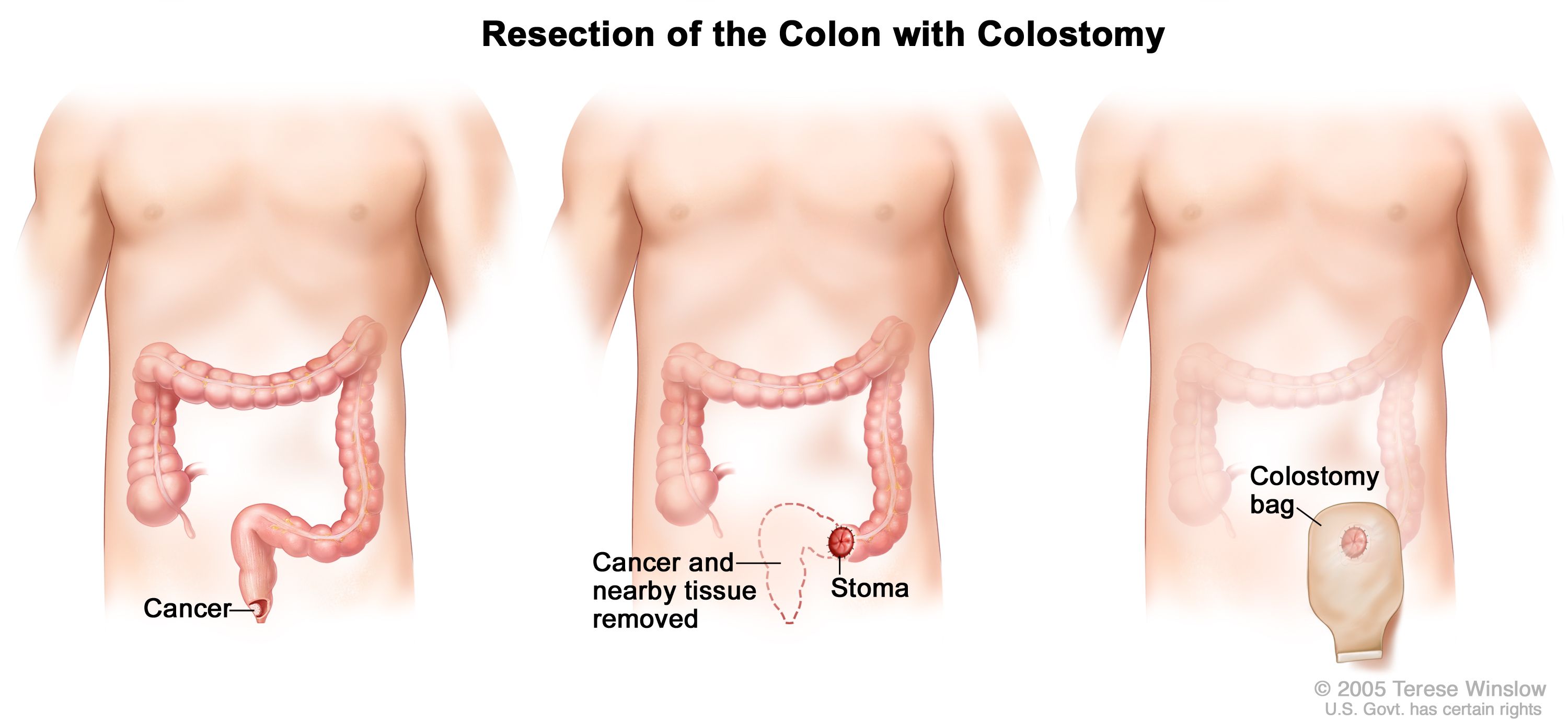 Anal Cancer: How to Diagnose, Staging and Treatment | Dana-Farber Cancer  Institute