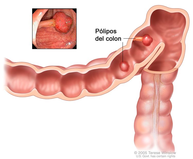 Pólipos del colon; se muestran dos pólipos (uno plano y otro pedunculado) en el interior del colon. En el recuadro se muestra una fotografía de un pólipo pedunculado.