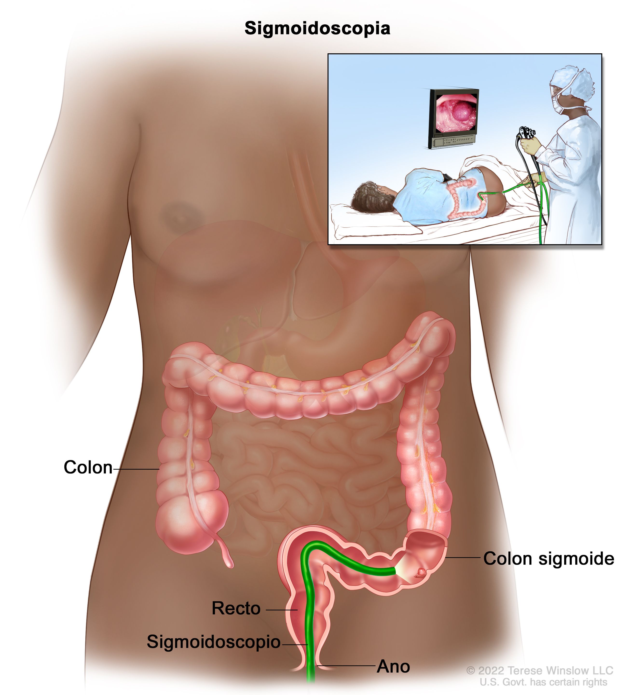 cancer de colon y diarrea