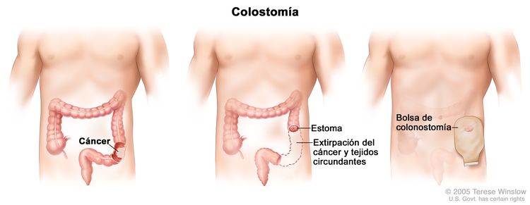 cancer de colon operacion complicaciones)