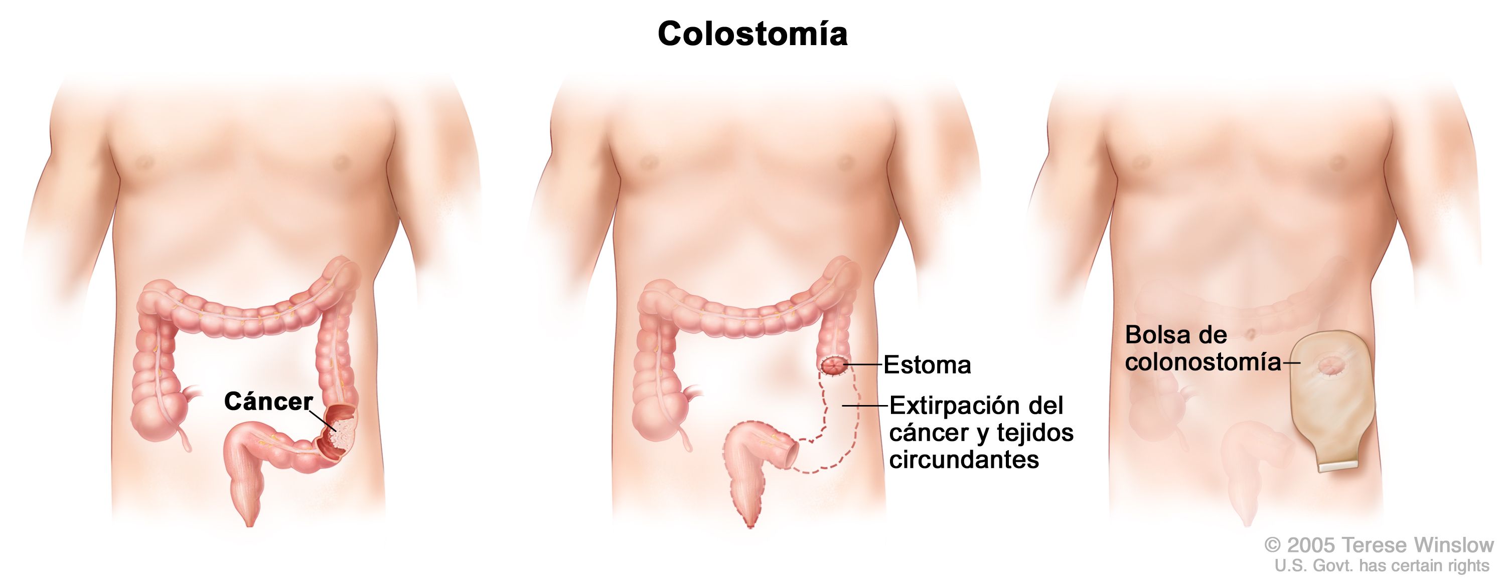 Cancer colon bolsa heces, Laryngeal papillomatosis cpt code