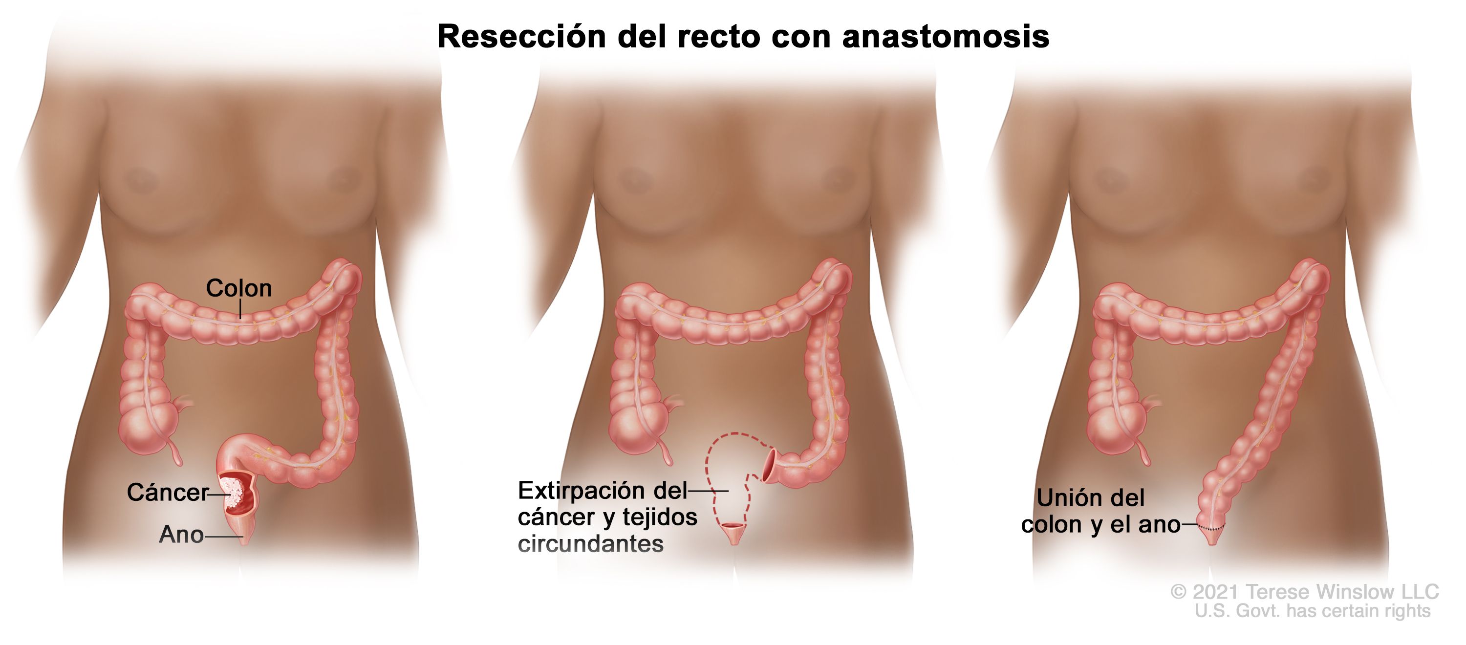 cancer rectal tratamiento)