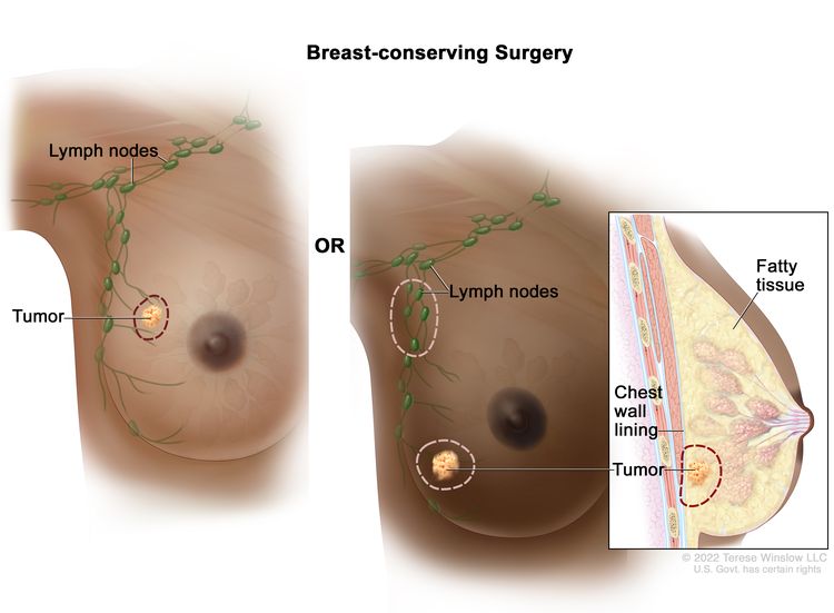 Breast-conserving surgery; the drawing on the left shows removal of the tumor and some of the normal tissue around it. The drawing on the right shows removal of some of the lymph nodes under the arm and removal of the tumor and part of the chest wall lining near the tumor. Also shown, is fatty tissue.