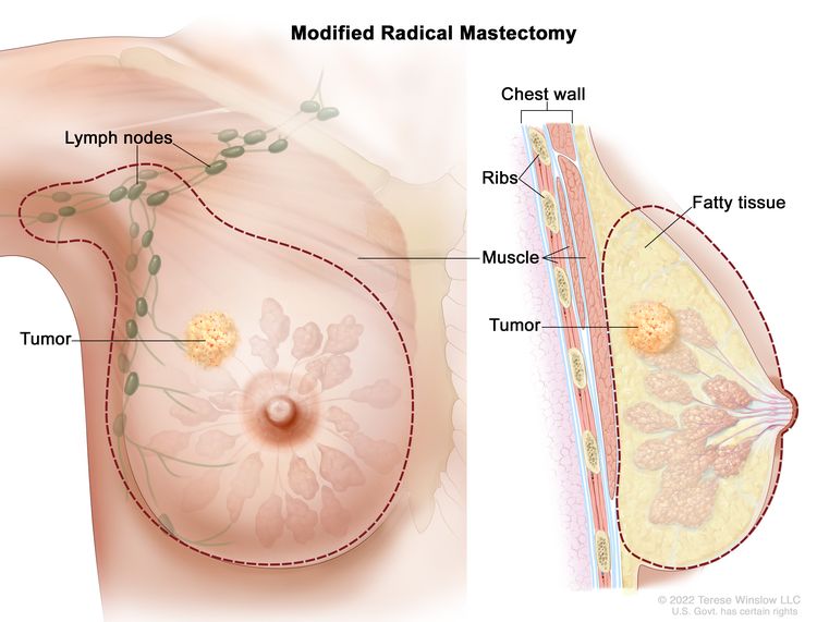 Modified radical mastectomy. The drawing on the left shows the removal of the breast, most or all of the lymph nodes under the arm, the lining over the chest muscles and sometimes part of the chest wall muscles. The drawing on the right shows a cross-section of the breast including the chest wall (ribs and muscle), fatty tissue, and the tumor.