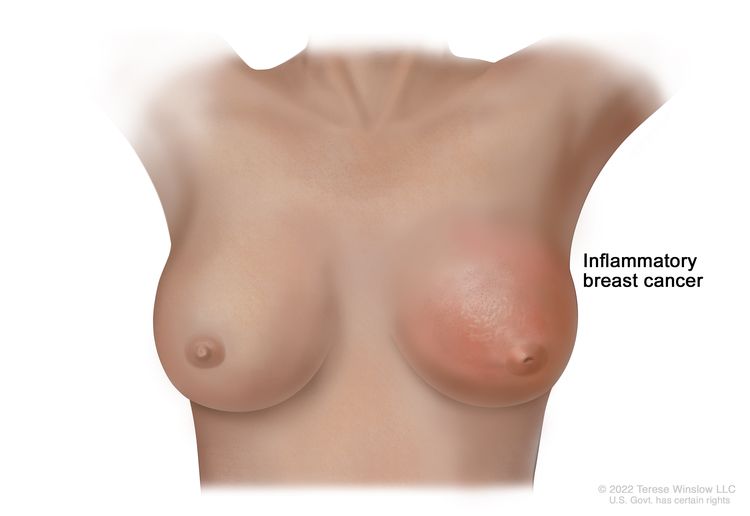 Inflammatory breast cancer of the left breast showing redness, swelling, peau d'orange, and an inverted nipple.