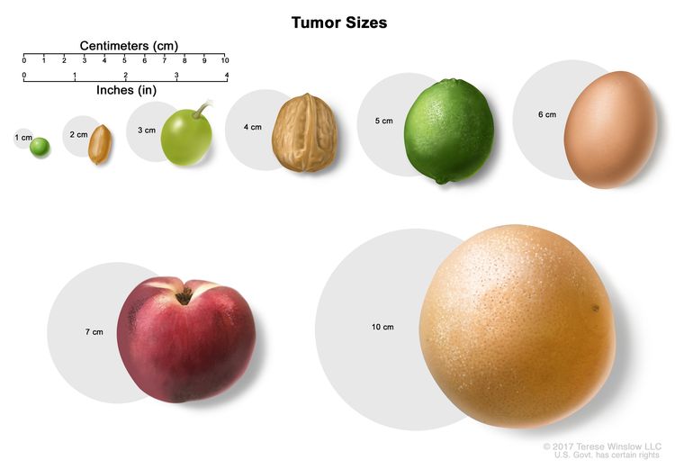 Soft Tissue Sarcoma Types, Staging and Treatment