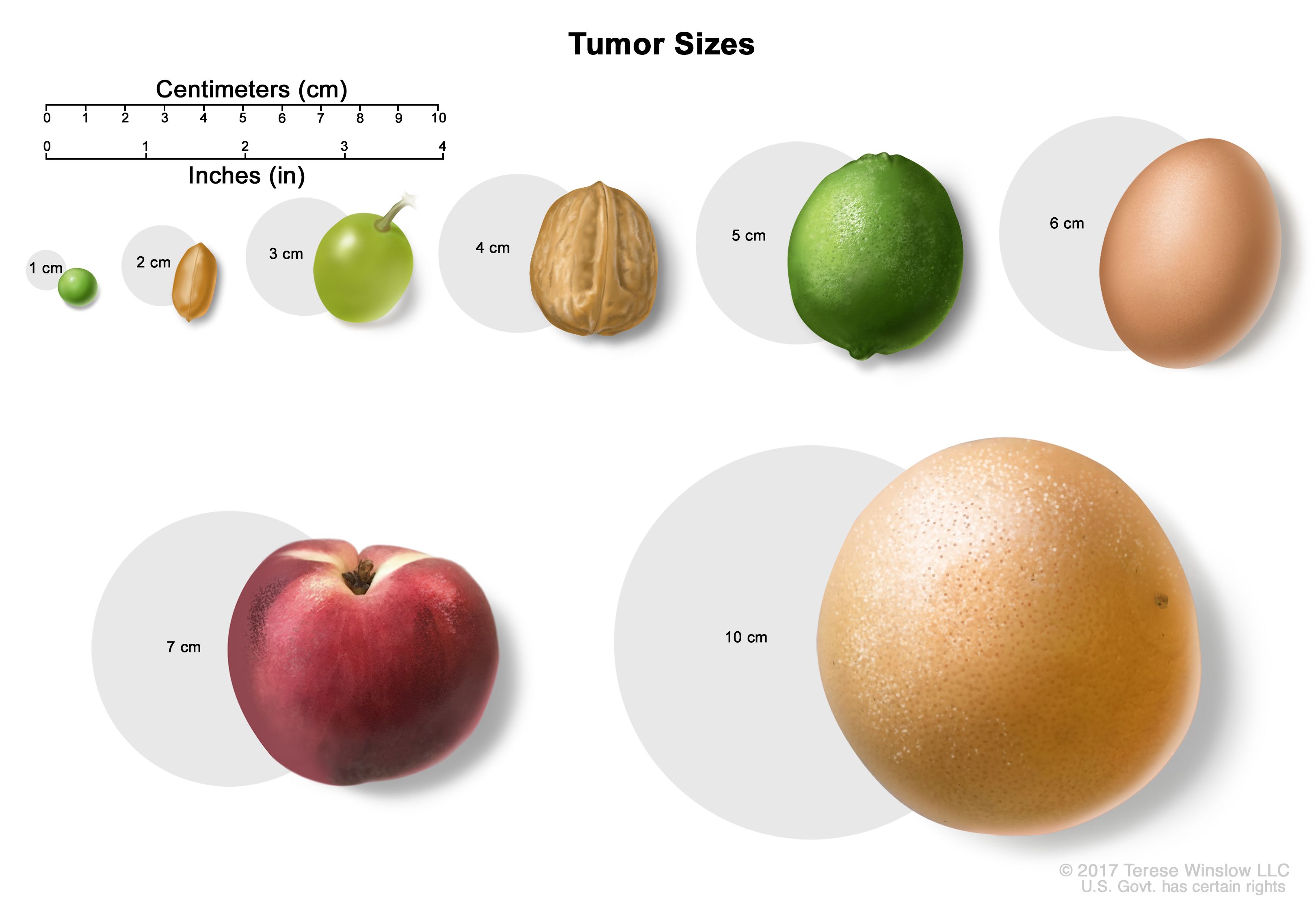 Etapas del carcinoma de la corteza suprarrenal