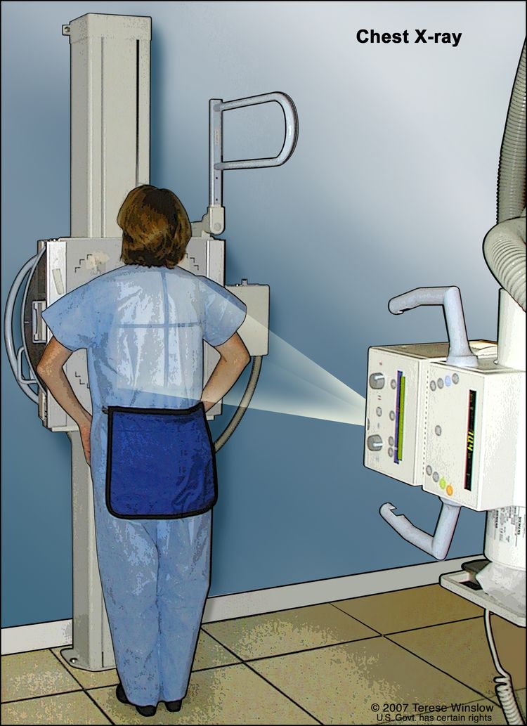 Chest x-ray; drawing shows a patient standing with their back to the x-ray machine. X-rays pass through the patient's body onto film or a computer and take pictures of the structures and organs inside the chest.