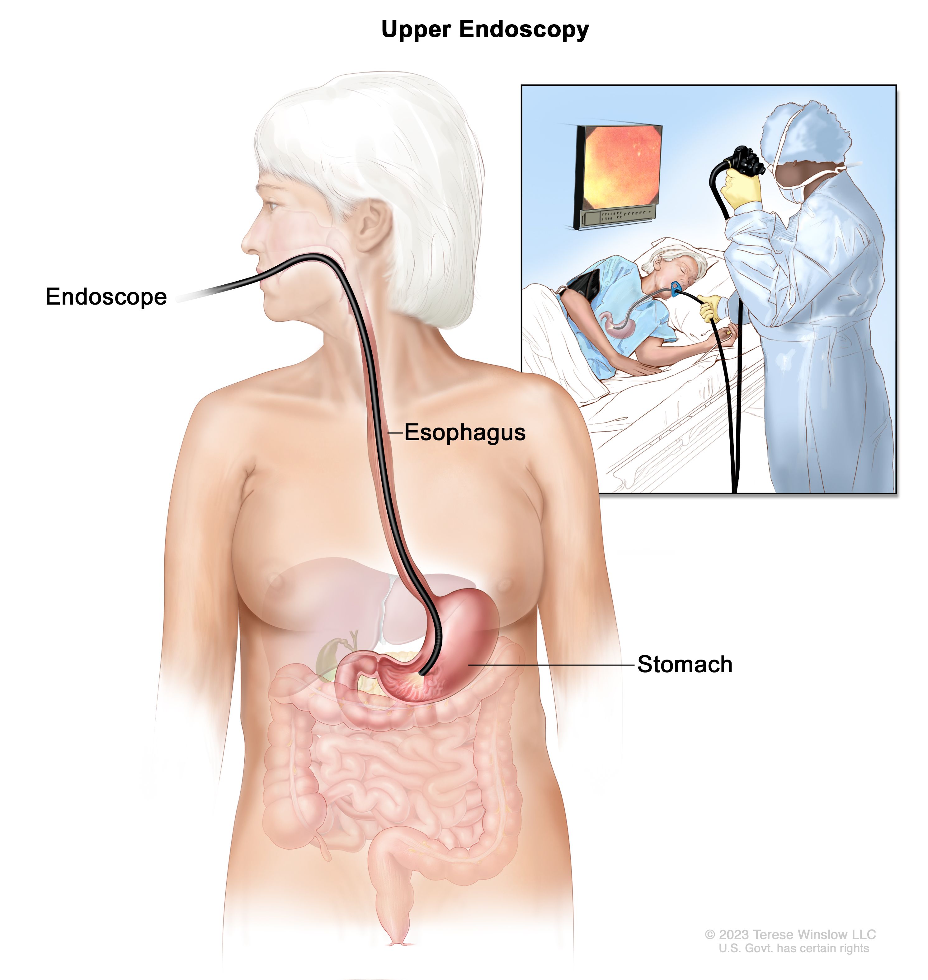 what is gastric cancer