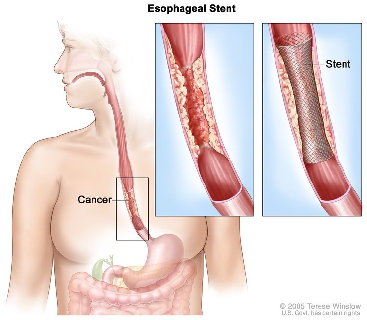 Esophageal stent. Shows cancer blocking esophagus. Insets show enlarged area of cancer and a stent placed in the esophagus to keep it open.