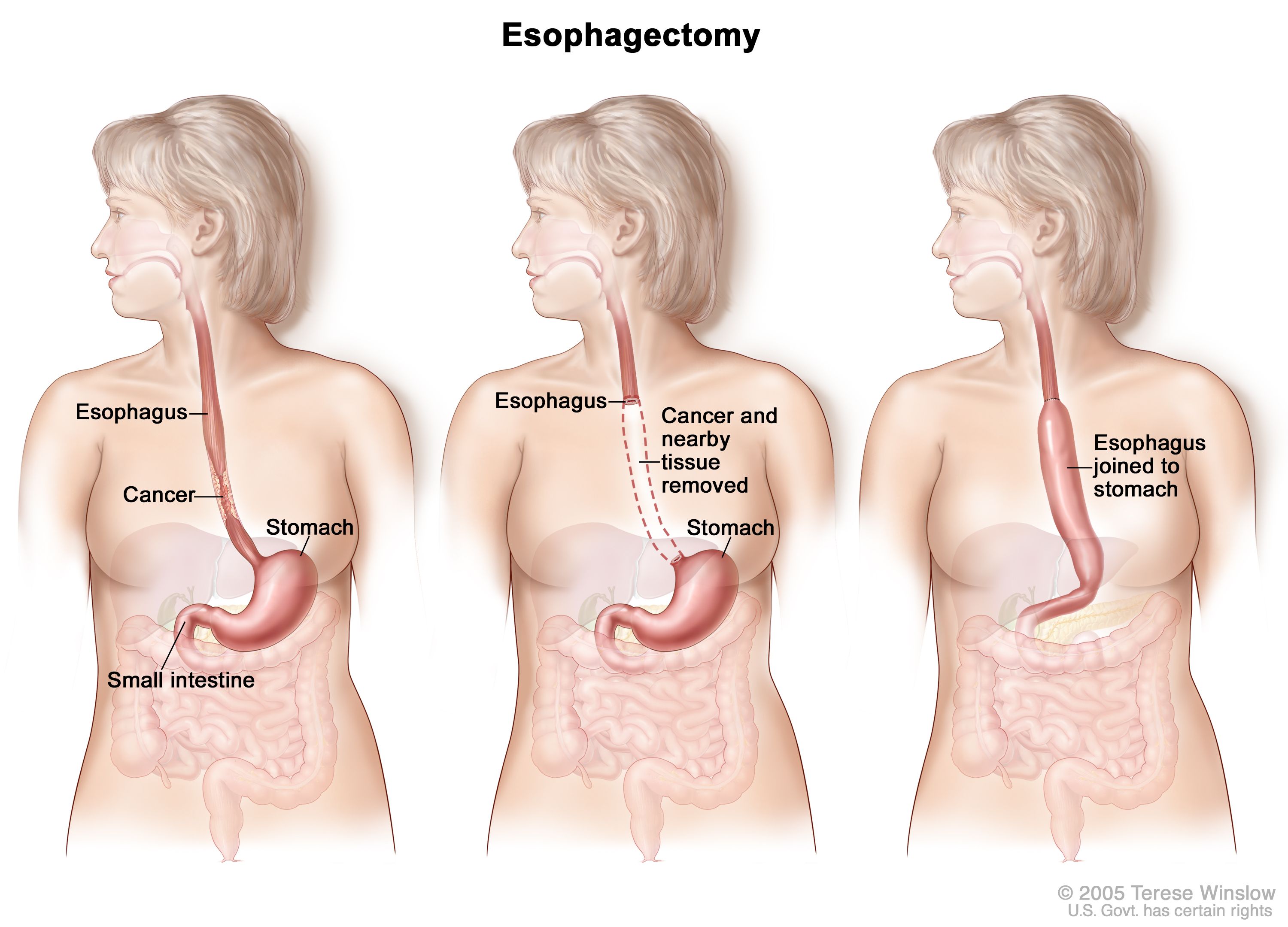 Esophageal Cancer Treatment Adult Pdq Patient Version National Cancer Institute