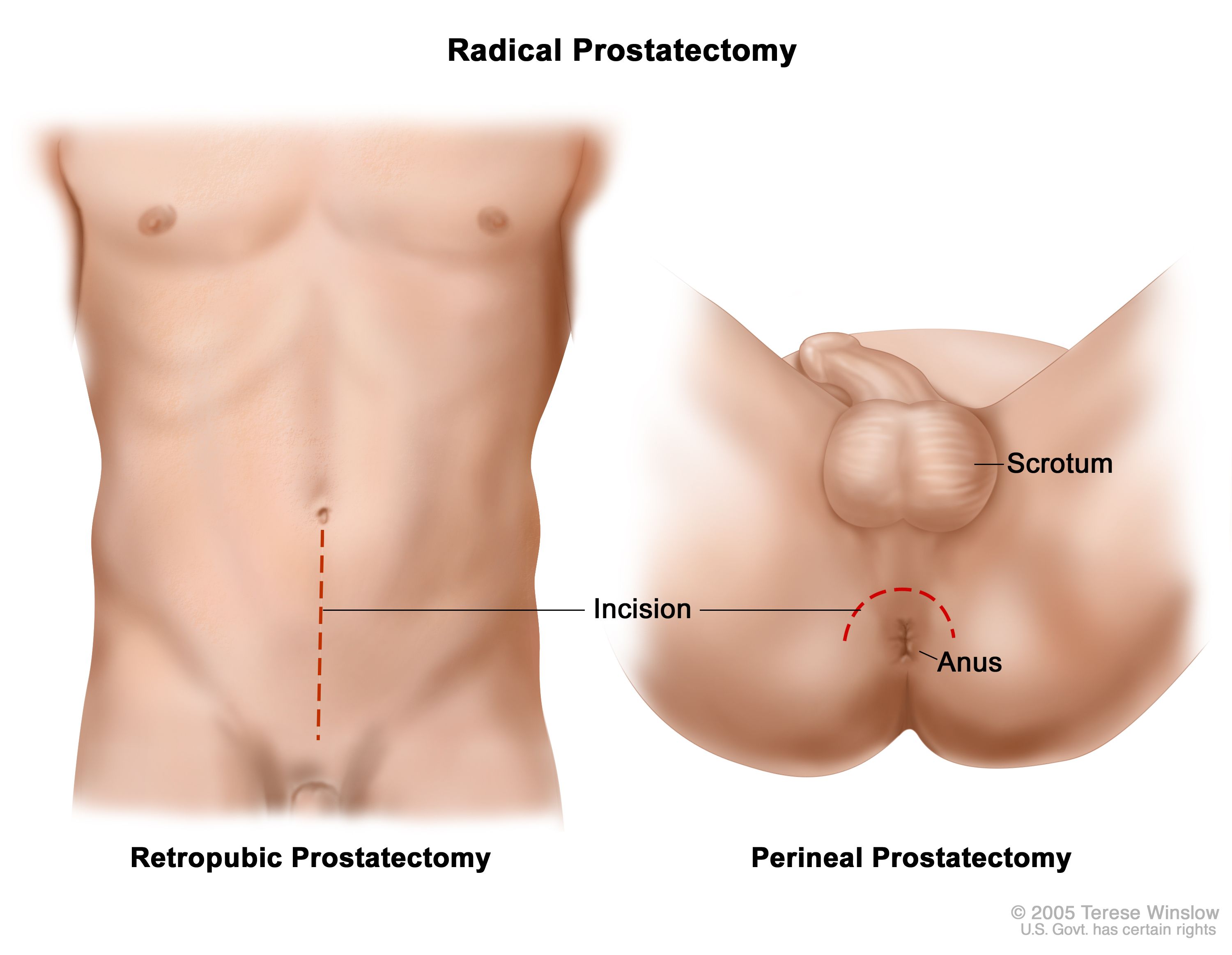 types of prostate surgery)