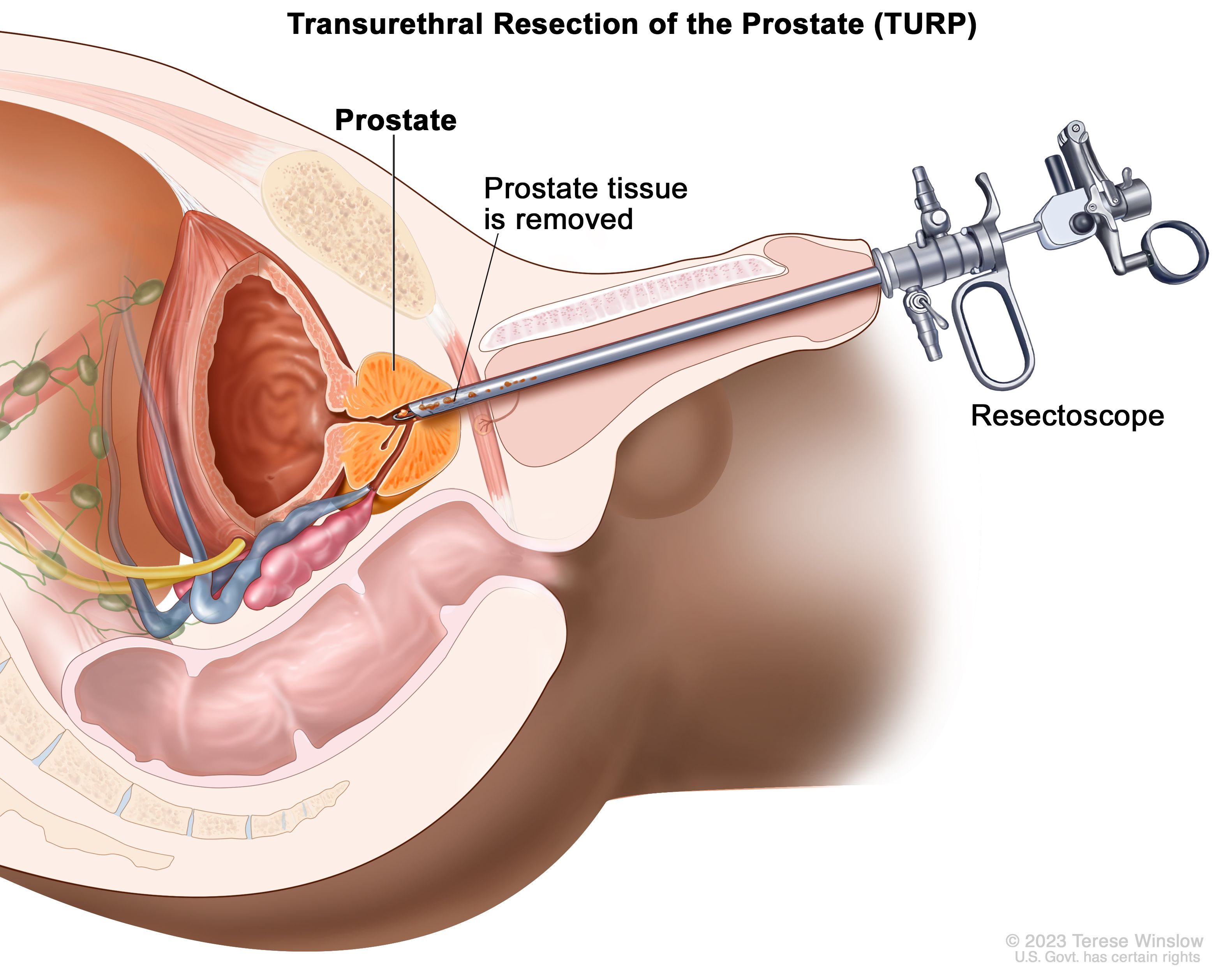 early prostate cancer treatment