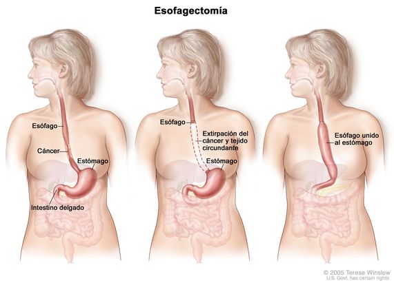 El dibujo a tres paneles muestra una cirugía del cáncer de esófago; el primer panel muestra el área del esófago con cáncer, el panel del medio muestra la extirpación del cáncer y el tejido circundante, y el último panel muestra como se estira el estómago y se une al resto del esófago.