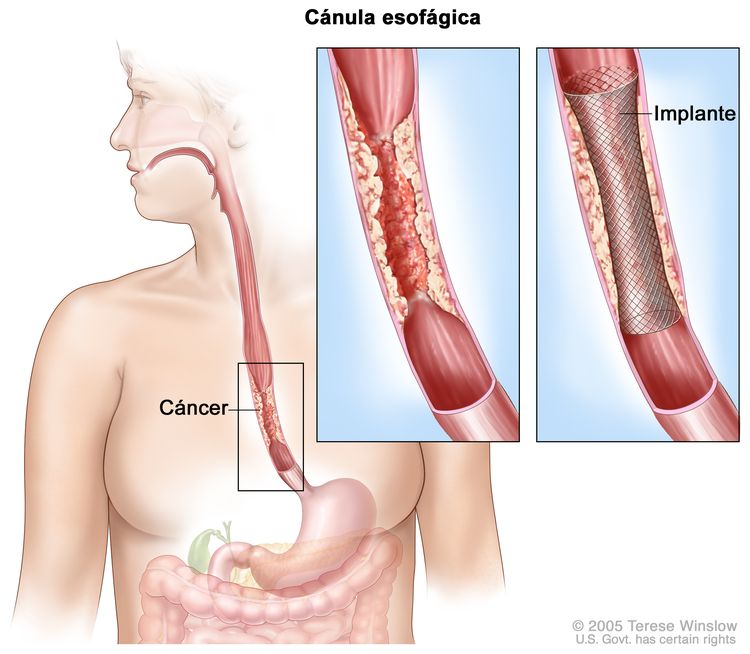 Implante esofágico. Se muestra el cáncer obstruyendo el esófago. El recuadro muestra una imagen ampliada del cáncer y el implante colocado en el esófago para mantenerlo abierto.