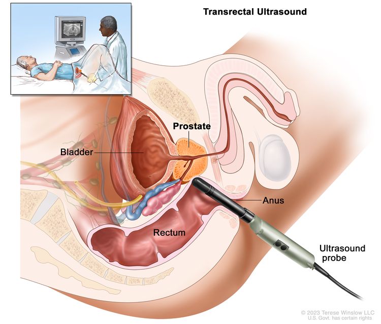 Transrectal ultrasound; drawing shows a side view of the male reproductive and urinary system anatomy, including the bladder and prostate. Also shown is the rectum and anus. There is also an ultrasound probe inserted into the rectum to check the prostate. An inset shows a provider inserting the ultrasound probe into the patient's rectum while viewing an image of the ultrasound on a computer screen. The patient is lying on their back on a table.