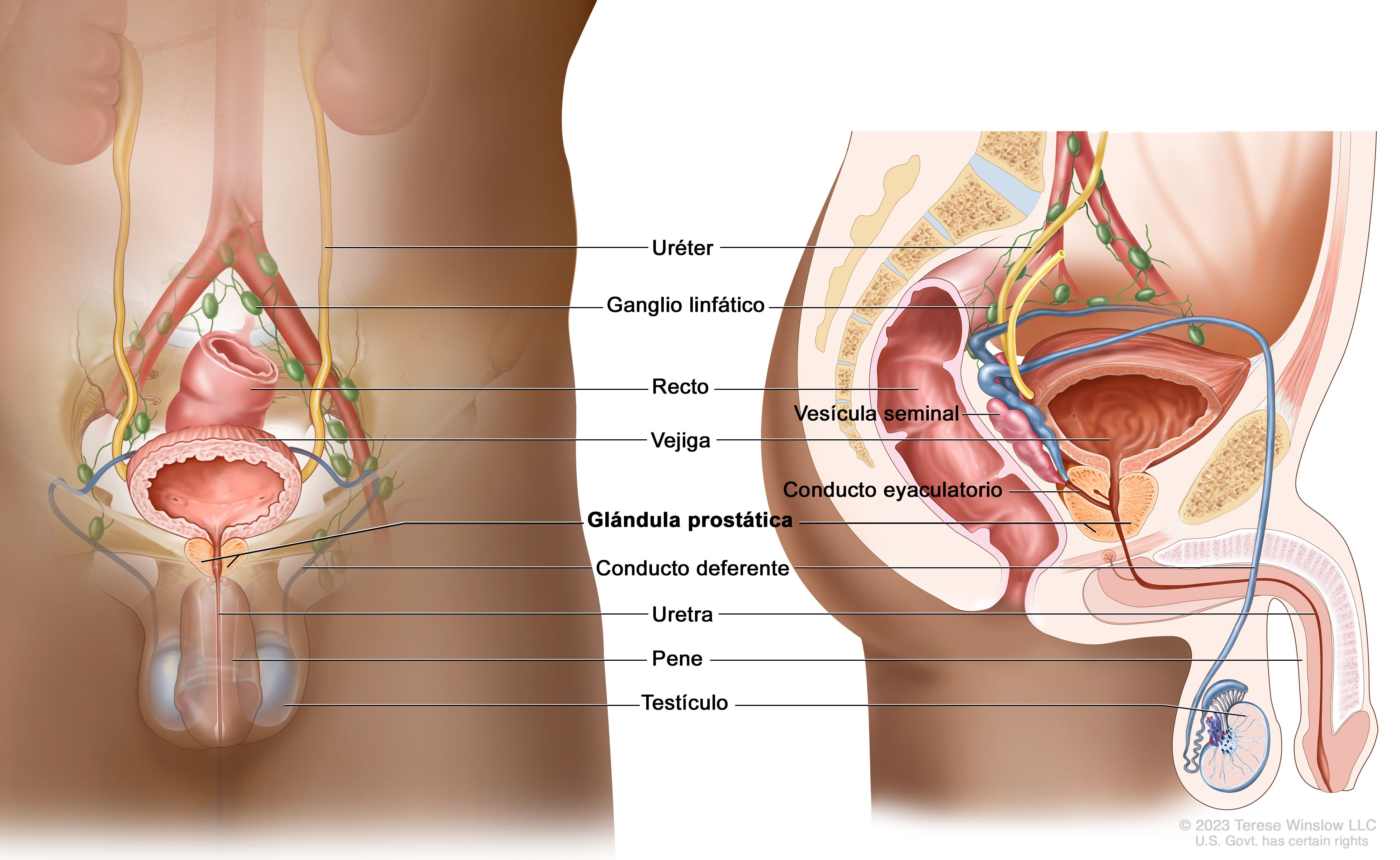 características patológicas del cáncer de próstata