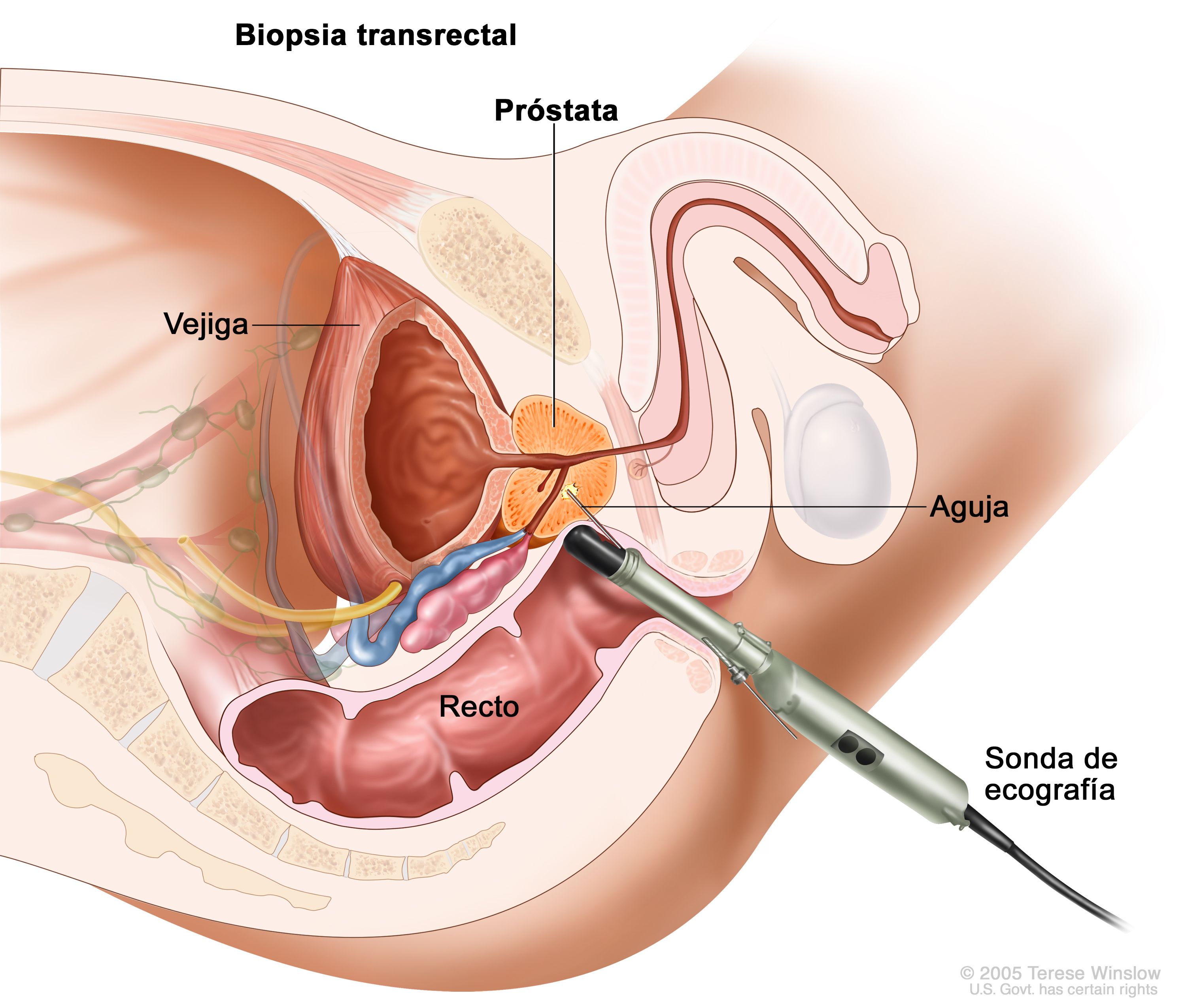 cuáles son los riesgos de una biopsia de próstata