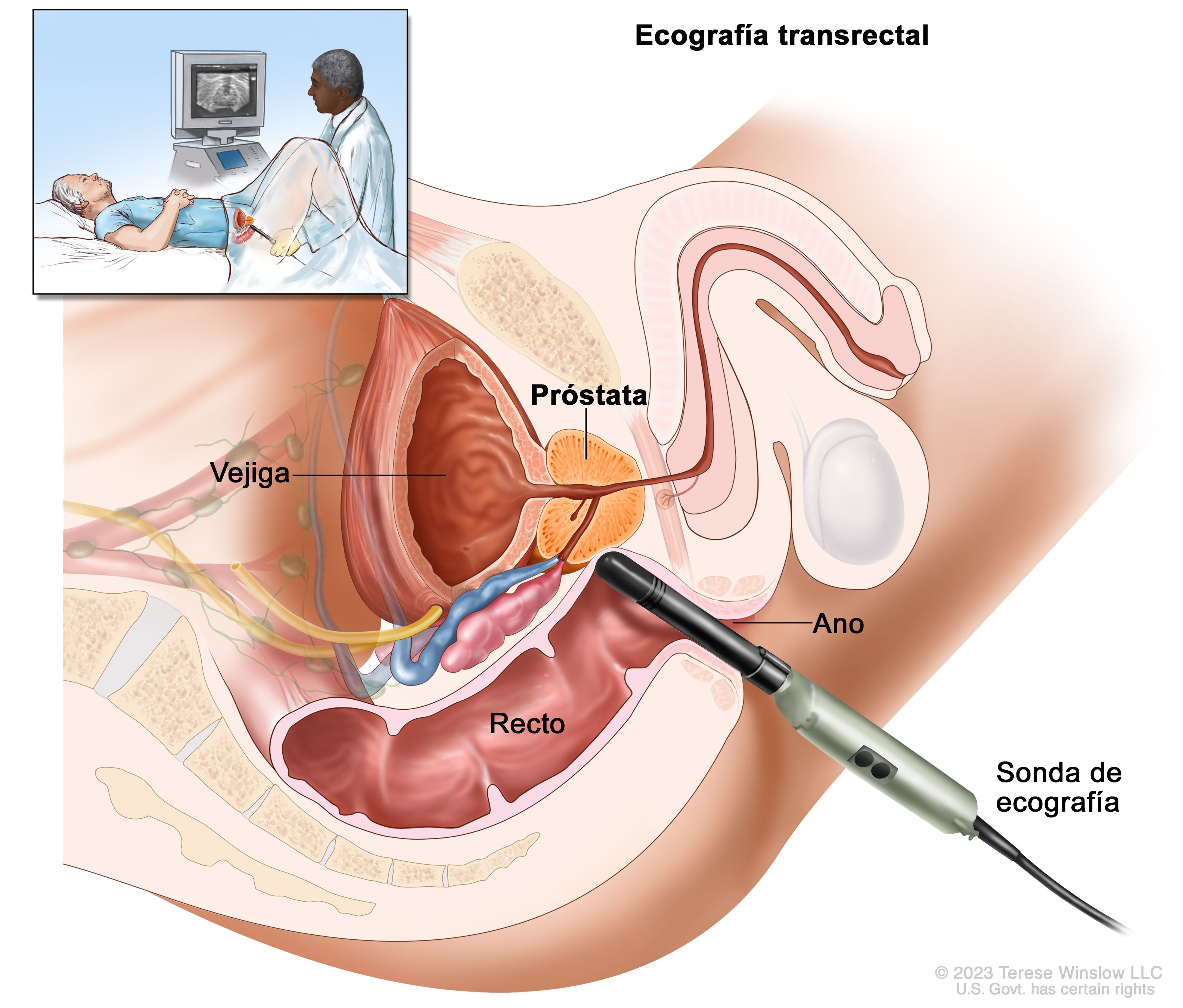 ecografia pelvica prostata)
