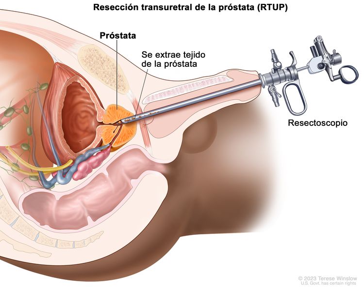 Resección transuretral de la próstata. En la imagen se observa la extracción de tejido de la próstata mediante un resectoscopio (tubo delgado con una luz y un instrumento cortante en su extremo) que se introduce a través de la uretra.