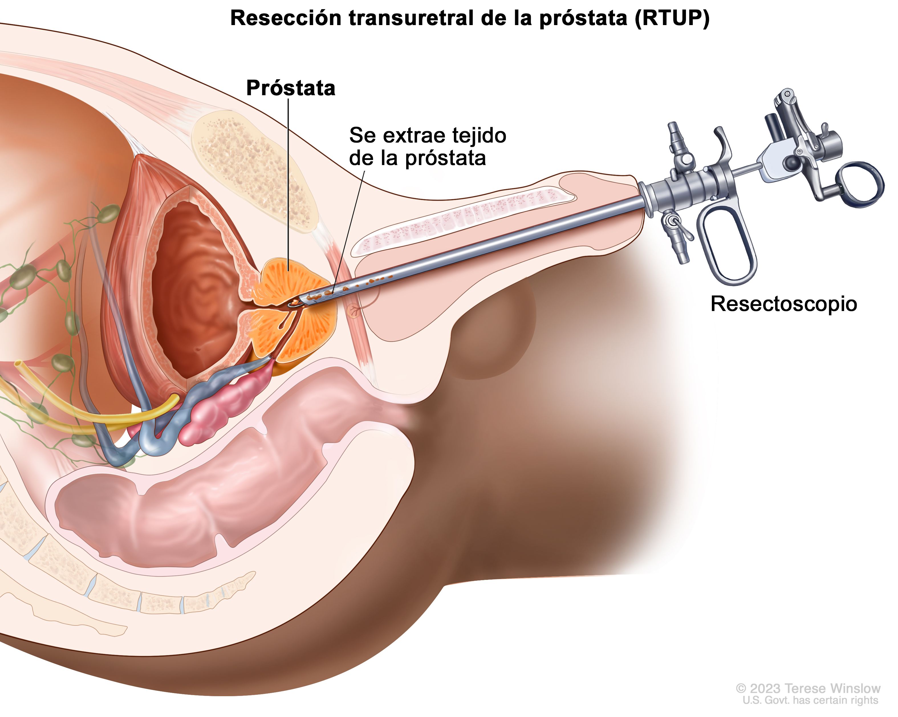 operatie prostata