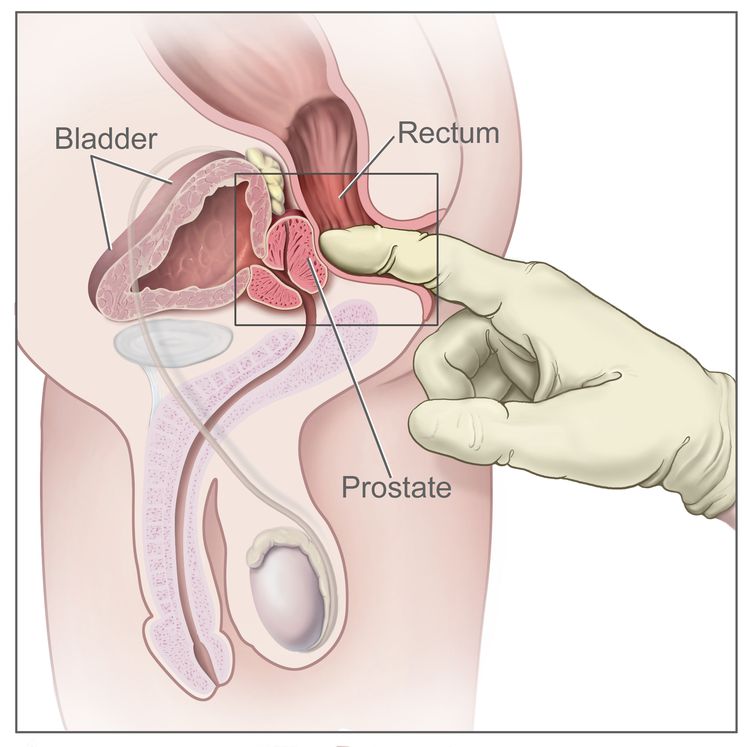 Digital rectal exam; drawing shows a side view of the male reproductive anatomy and the urinary anatomy, including the prostate, rectum, and bladder. Also shown is a gloved, lubricated finger inserted into the rectum to feel the rectum, anus, and prostate.