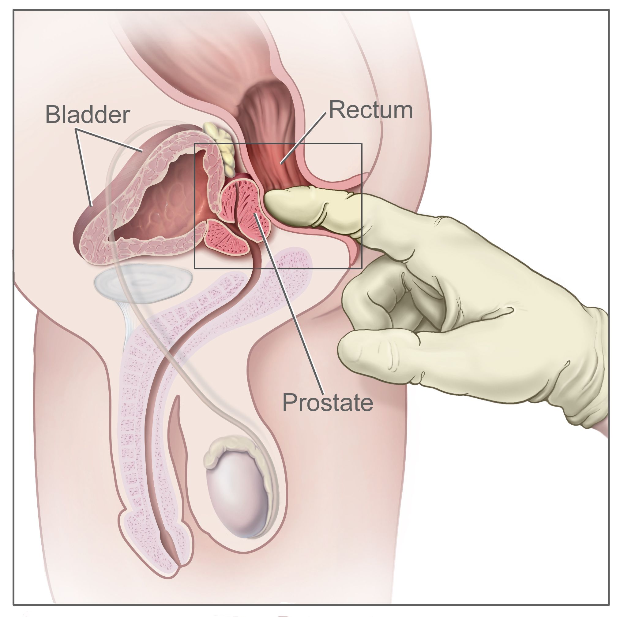 Chistul testicular și potența, Rectal cancer lump Rectal cancer lump