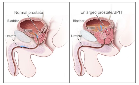prostatic hyperplasia meaning)