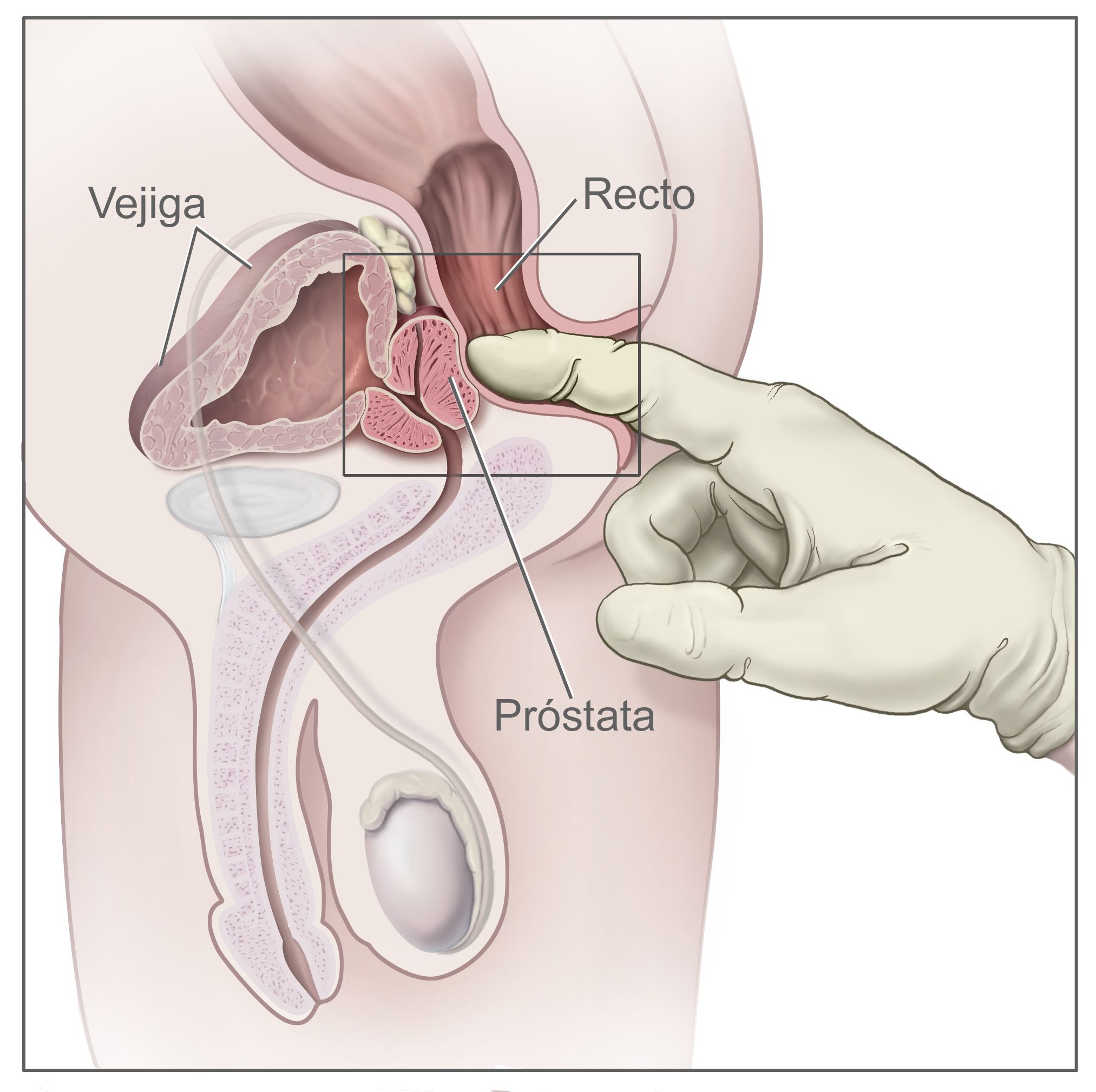 como se realiza el examen de prostata