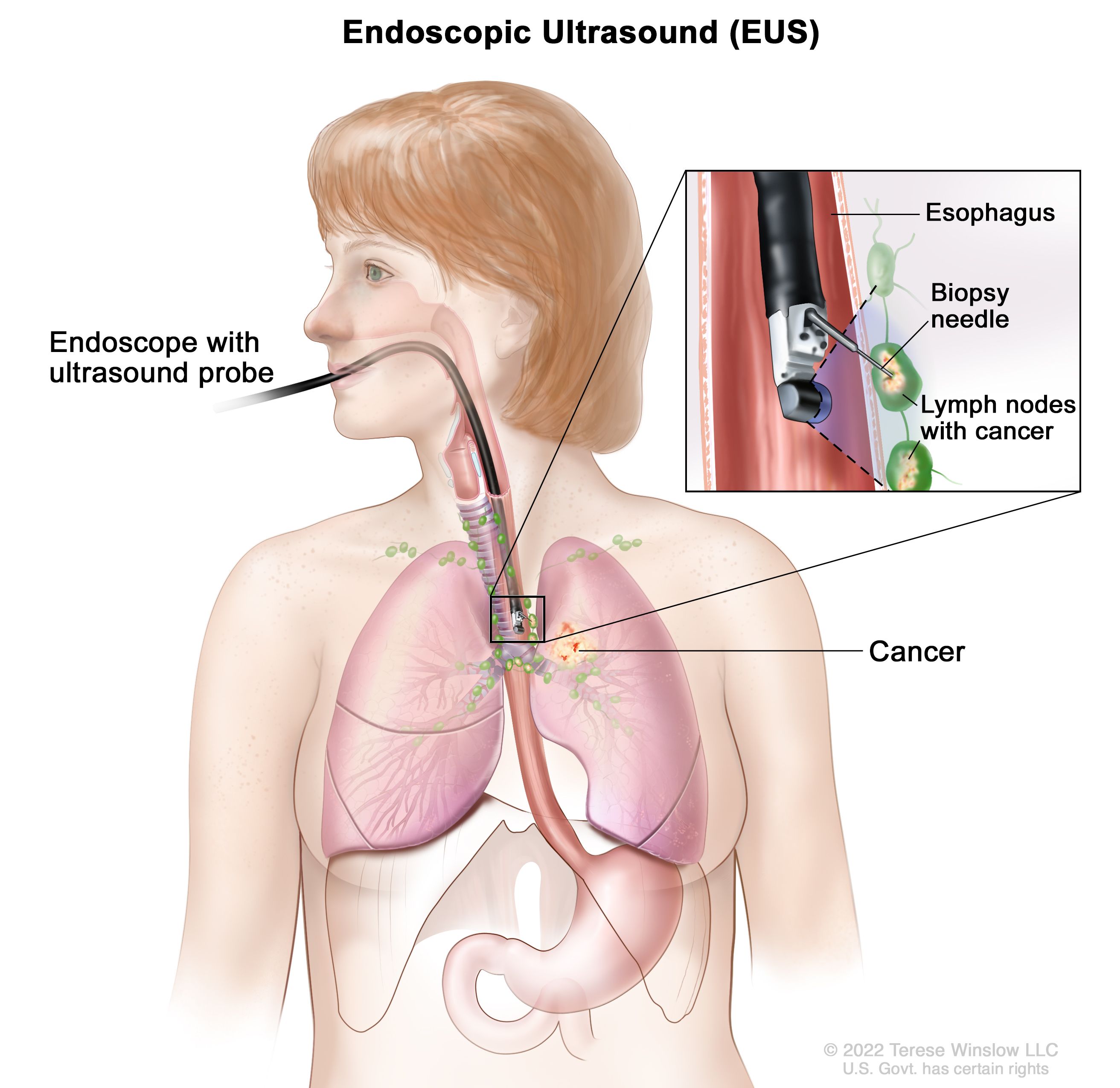 what are the chances of surviving cancer of the esophagus