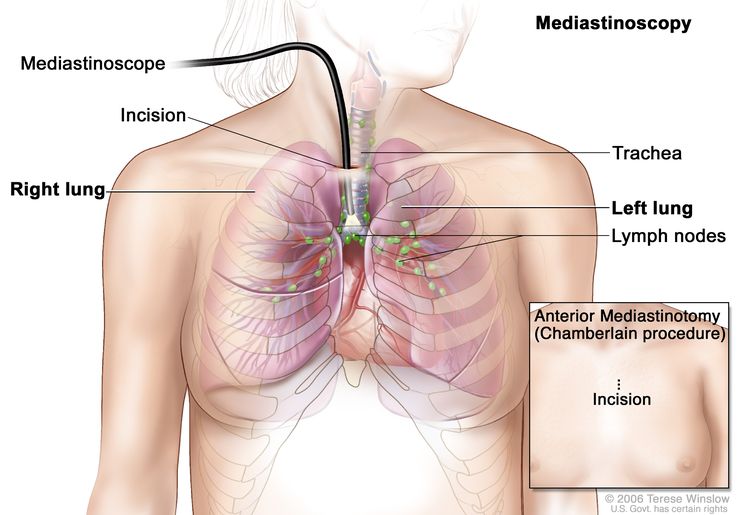 Mediastinoscopy; shows mediastinoscope with light and lens inserted into the chest through an incision above the breastbone. Drawing shows right and left lungs, trachea, and lymph nodes. Inset shows anterior mediastinotomy (Chamberlain procedure) with incision beside the breastbone.