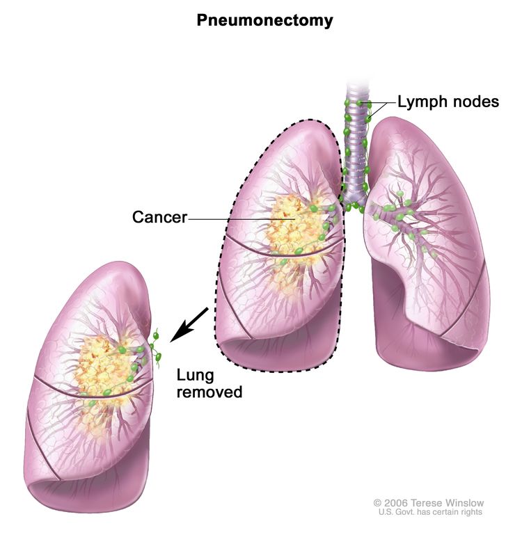 Pneumonectomy; drawing shows the trachea, lymph nodes, and lungs, with cancer in one lung. The removed lung with the cancer is shown.