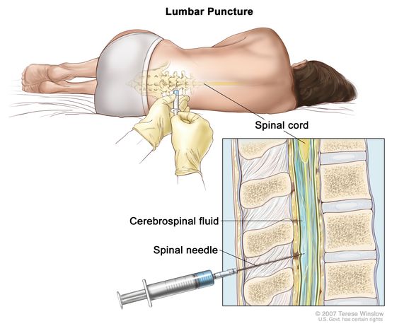 Definition of lumbar puncture - NCI 