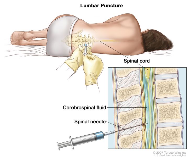Lumbar puncture; drawing shows a patient lying in a curled position on a table and a spinal needle (a long, thin needle) being inserted into the lower back. Inset shows a close-up of the spinal needle inserted into the cerebrospinal fluid (CSF) in the lower part of the spinal column.
