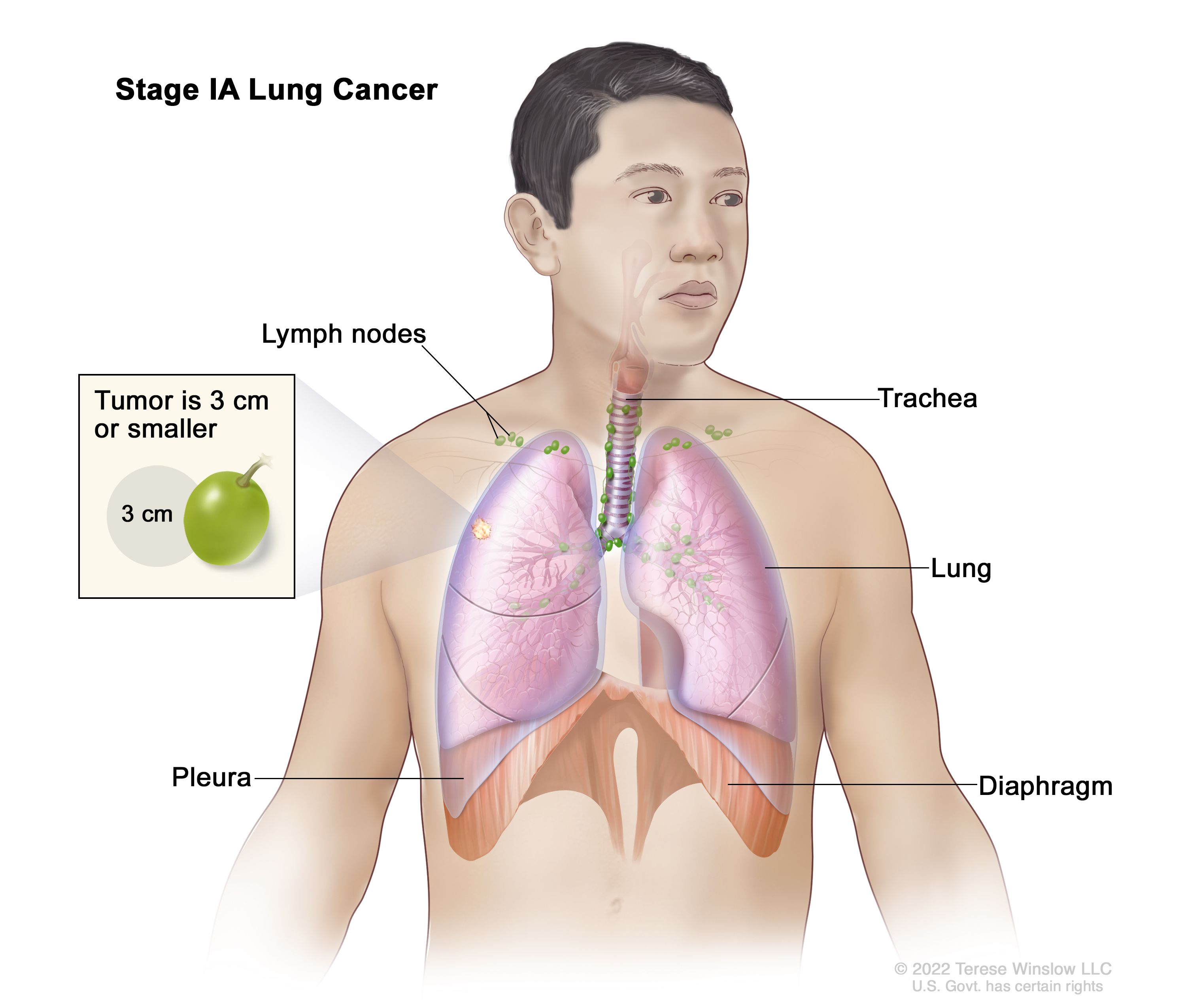 lung cancer cells diagram