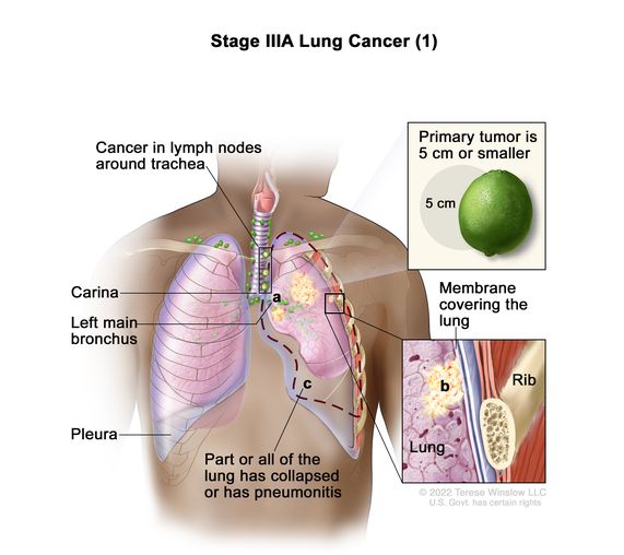 Definition Of Stage Iiia Non Small Cell Lung Cancer Nci Dictionary Of Cancer Terms National Cancer Institute