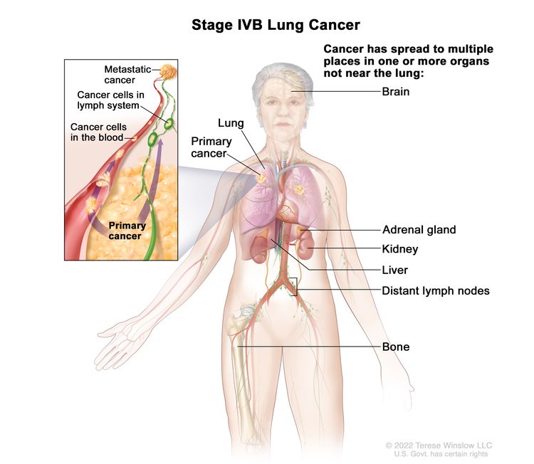 sarcoma cancer in lungs paraziți în tratamentul corpului nostru
