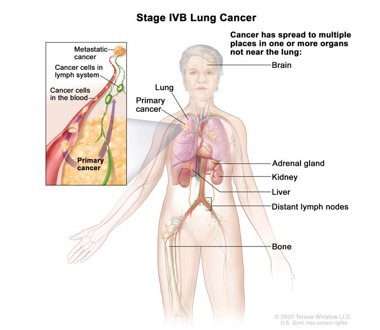 Non Small Cell Lung Cancer Treatment Pdq® Nci 