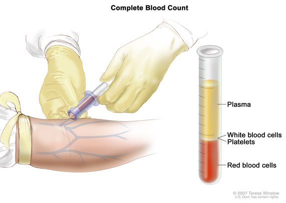 Tam kan sayımı (CBC);  sol panel, bir şırıngaya bağlı bir tüp kullanılarak dirseğin iç kısmındaki bir damardan alınan kanı göstermektedir;  sağ panel, katmanlara ayrılmış kan hücrelerine sahip bir laboratuvar test tüpünü gösterir: plazma, beyaz kan hücreleri, trombositler ve kırmızı kan hücreleri.