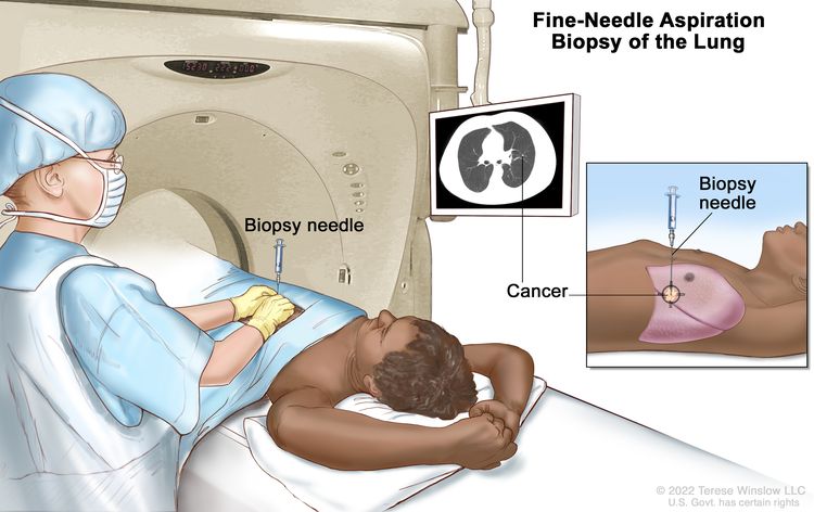 Fine-needle aspiration biopsy of the lung; drawing shows a <a href=