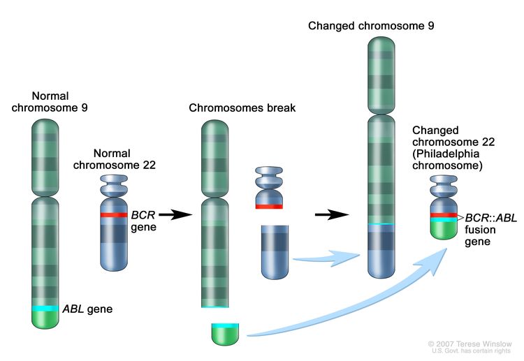 Philadelphia chromosome; three-panel drawing shows a piece of chromosome 9 and a piece of chromosome 22 breaking off and trading places, creating a changed chromosome 22 called the Philadelphia chromosome. In the left panel, the drawing shows a normal chromosome 9 with the ABL gene and a normal chromosome 22 with the BCR gene. In the center panel, the drawing shows chromosome 9 breaking apart in the ABL gene and chromosome 22 breaking apart below the BCR gene. In the right panel, the drawing shows chromosome 9 with the piece from chromosome 22 attached and chromosome 22 with the piece from chromosome 9 containing part of the ABL gene attached. The changed chromosome 22 with the BCR-ABLgene is called the Philadelphia chromosome.